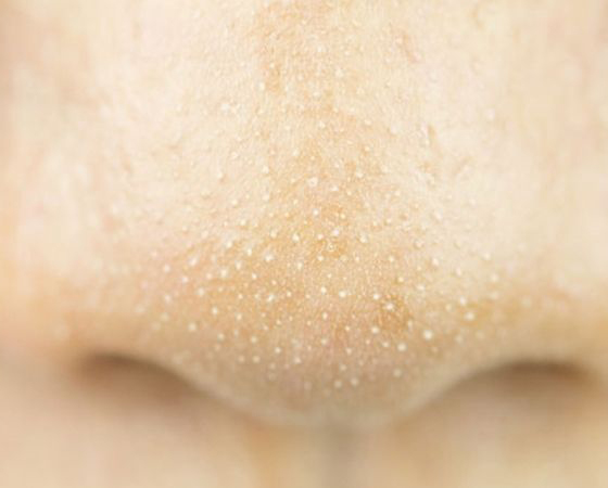  Trị Mụn Ẩn Và Mụn Cám Tại Sen Beauty